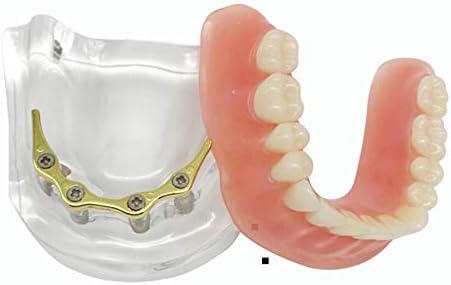 Kh66zky overdenture מודל הוראה נחות - מודל שיניים שיניים - ציוד הדגמה סטנדרטית של רופא שיניים ללימודים